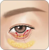 Illustration of under eye fat being removed