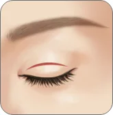 Illustration of the incision line