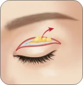 Illustration of excess skin being removed