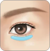 Illustration of volume added under the lower lashes