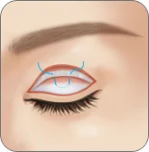 Illustration of the lifting muscle being tightened