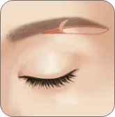 Illustration of the incision below the brow