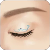 Illustration of the suture method thread line